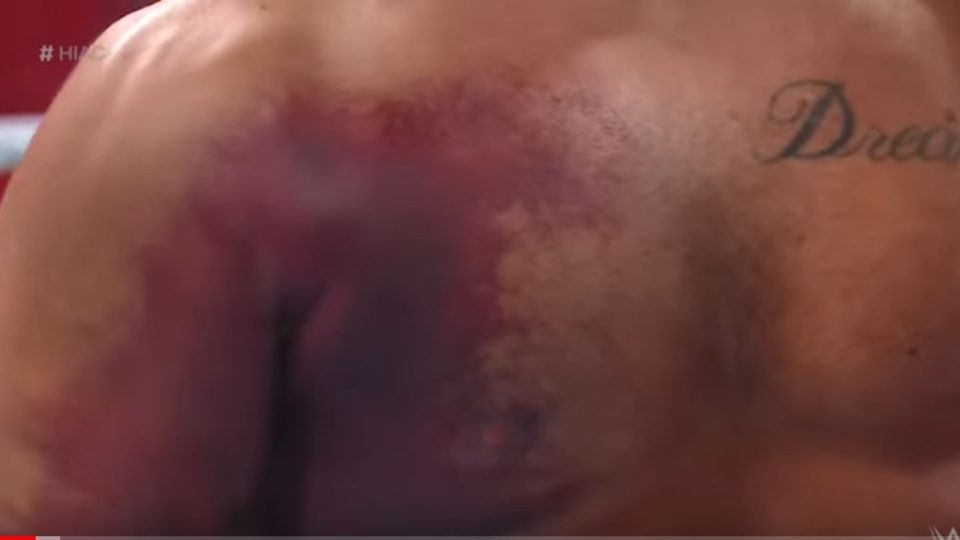 cody rhodes seth rollins torn pec