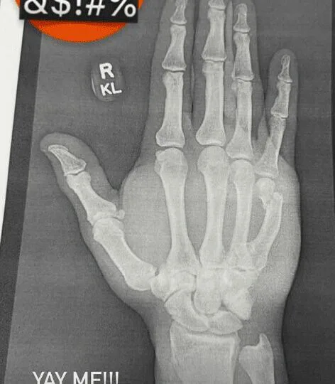 braun strowman wwe injury x-ray